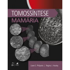 Tomossíntese mamária