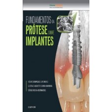 Fundamentos da prótese sobre implantes