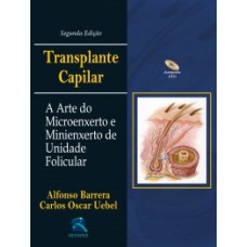 Transplante capilar