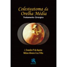 Colesteatoma da orelha média