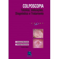 Colposcopia