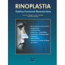 Rinoplastia