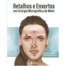 Retalhos e Enxertos em Cirurgia Micrográfica de Mohs