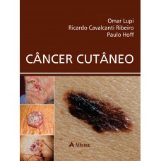 Câncer Cutâneo