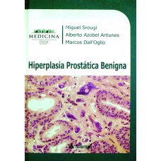 Hiperplasia prostática benigna Hiperplasia prostática benigna